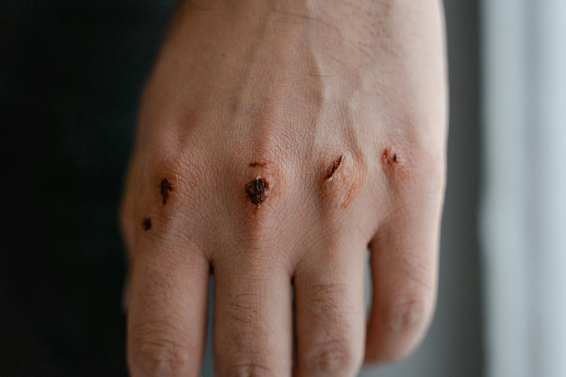 Close-up view of a hand showing scars and injuries on the knuckles.